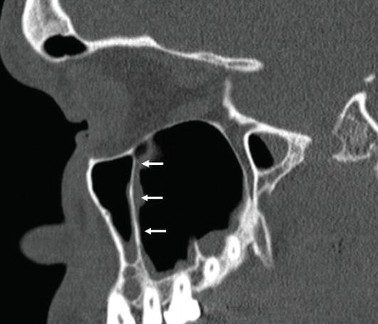Paranasal Sinus Anatomy: What the Surgeon Needs to Know | IntechOpen