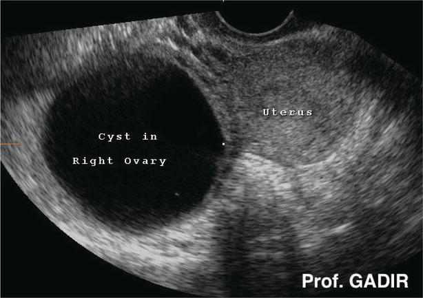 ovarian cancer with pregnancy)