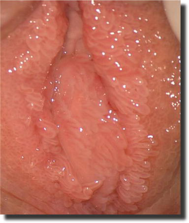 Vestibularis papillae vs genitális szemölcsök