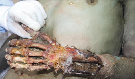 Postmortem Animal Attacks on Human Corpses | IntechOpen
