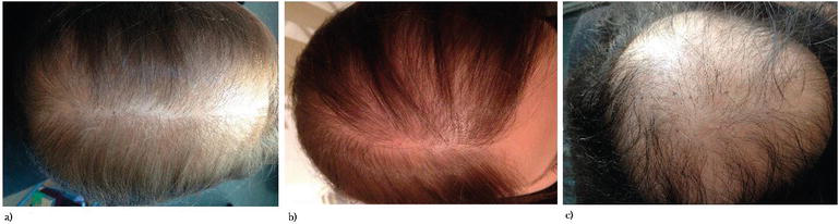 Evaluation of Patients with Alopecia | IntechOpen