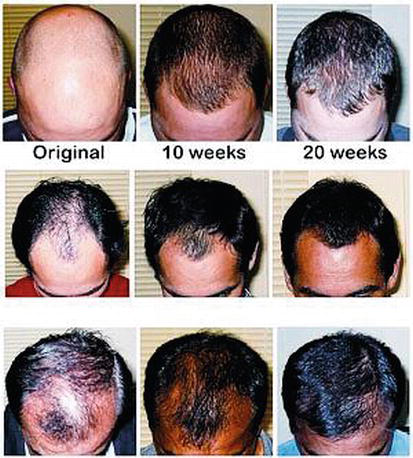 Pharmacological Treatment of Alopecia | IntechOpen