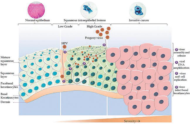 human papillomavirus and related cancers