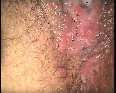 Black Spots Around Vagina