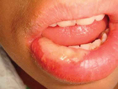 Oral Mucosal Trauma And Injuries Intechopen