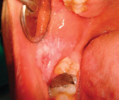 Oral Mucosal Trauma And Injuries Intechopen