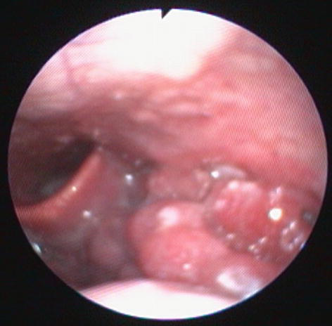 hpv cancer on base of tongue condyloma acuminata etiology