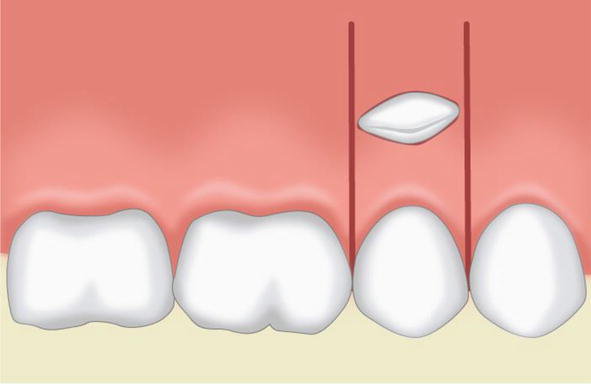 Flap Techniques in Dentoalveolar Surgery | IntechOpen