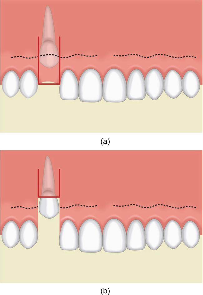 Flap Techniques in Dentoalveolar Surgery | IntechOpen