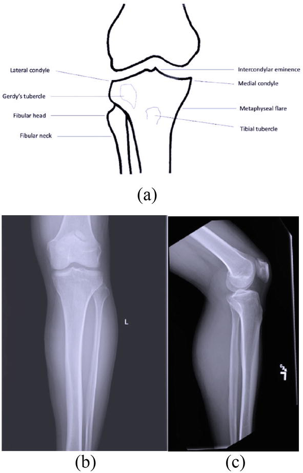 Stress running plateau tibial fracture Should a