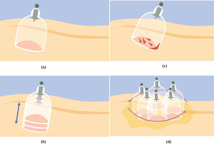 The Role of Cupping Therapy in Pain Management: A Literature Review |  IntechOpen