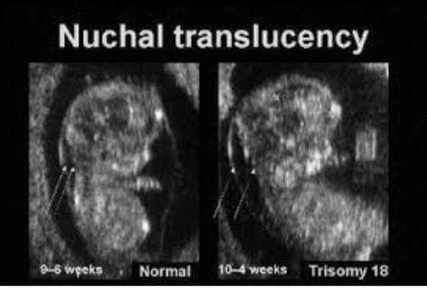 Nuchal fold what is a Nuchal translucency