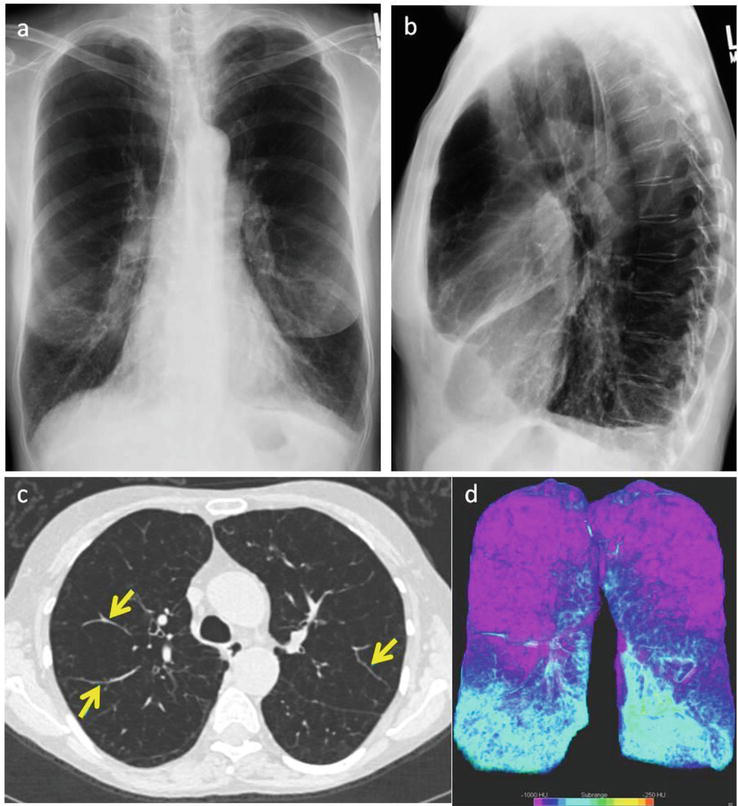 Imaging of Emphysema: A Comprehensive Review | IntechOpen